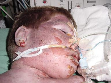 photo stevens johnson syndrome number 12