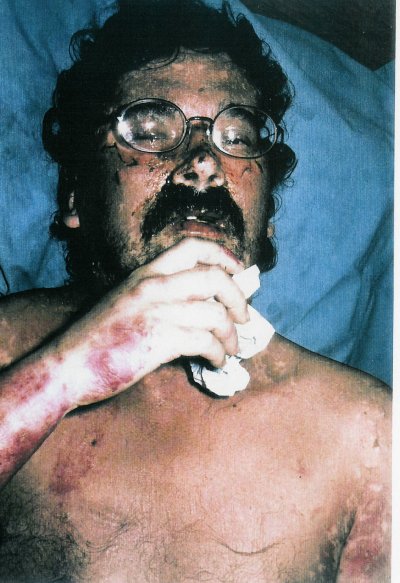 photo stevens johnson syndrome number 3