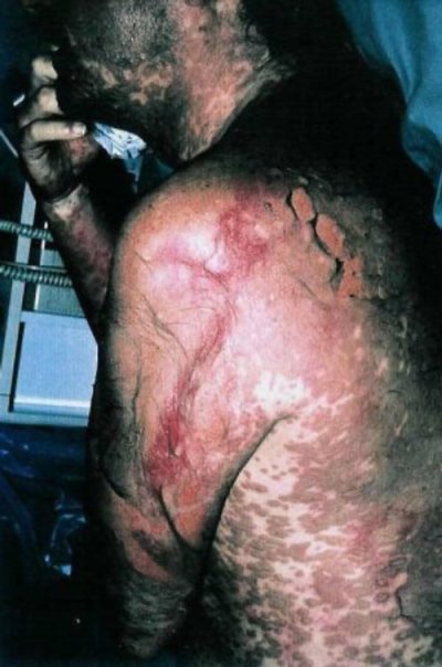 photo stevens johnson syndrome 2